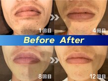 アリッサムフォーメン 岡山店(ALiSSUM for men)/1回目→4回目→8回目→12回目