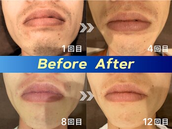 アリッサムフォーメン 岡山店(ALiSSUM for men)/1回目→4回目→8回目→12回目