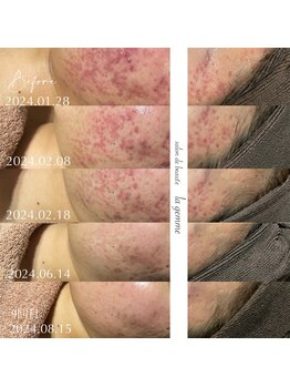 ラ ジェム(la gemme)/オーダーメイドニキビケア