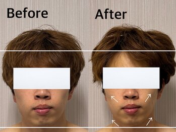 ベール(BEHL)/コルギのBefore After