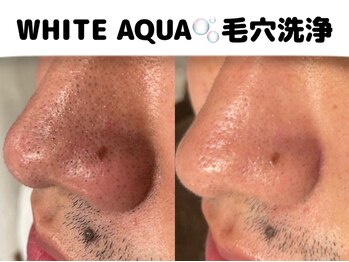 ホワイトアクア 柏店(WHITE AQUA)/ハイドラフェイシャル/肌管理