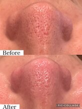 ウォーム(Warm)/毛穴エクストラクションとハーブ