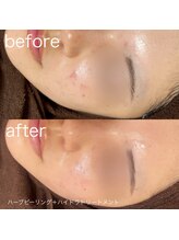 ルルラ リコ(lulula rico)/症例写真/ハーブピーリング