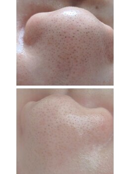 ホッコリリィ/毛穴ハイドロ　BeforeAfter