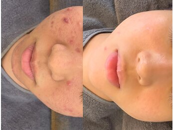 レペリオビューティーサロン(reperio beauty salon)の写真/【自分史上最高美肌】極上フェイシャルマッサージで内側から発光するツヤ肌へ♪メイクのりも格段にUP！