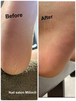 ミリミリ(Milimili)/角質除去