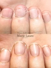 マリーロール 梅田店(Marie Laure)/自爪育成/深爪矯正/ネイルケア