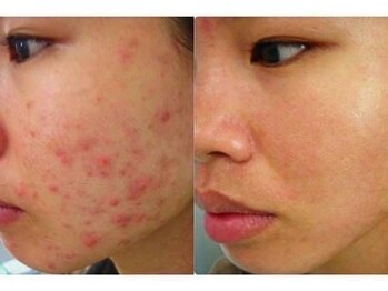 フォフォ 仙台泉店(Fofo)/話題の韓国式ハーブピーリング　