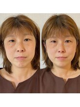 金の指銀の指/小顔矯正ビフォーアフター２