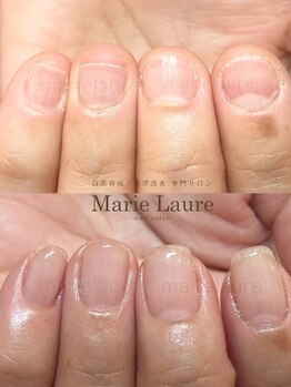マリーロール 梅田店(Marie Laure)/深爪矯正/自爪育成/自爪風