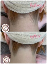 ラウレア 西条店(LAULEA)/襟足脱毛　before/after