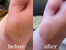 ドクターネイル爪革命 札幌本店/症例紹介２３　たこ