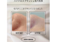 ハイドロ吸引と洗浄、AHA&BHAピールローションで毛穴すっきり