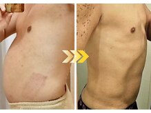 サロンドモモ(SALON de MOMO)/脂肪冷却×ウィンバック