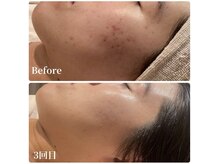 ウルソワン 都島店(/ulu soin)/ニキビ改善3回