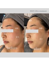 ラヴニール(L'avenir)/ニキビケアにはこれ！