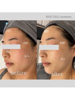 ラヴニール(L'avenir)/ニキビケアにはこれ!