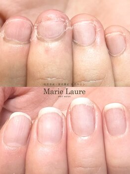 マリーロール 梅田店(Marie Laure)/自爪育成/深爪矯正/ネイルケア
