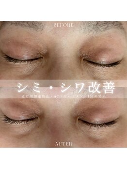 ヴィヴィアン 太田川店(Vivian)/気になるシワも改善！