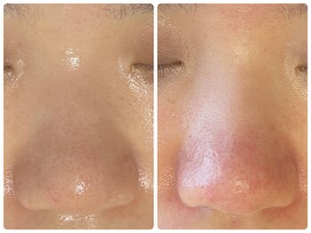 ラヴィ(Ravi)/鼻毛穴ケア、赤み改善