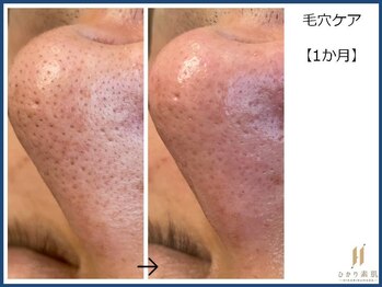 ひかり素肌/鼻の毛穴ケア1回