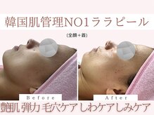 Cスキンケアクリニック 麻布店/ララピールBeforeAfter #東麻布