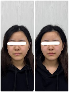 ラフテル鍼灸整骨院/雨の日のむくみはヘッドスパが◎