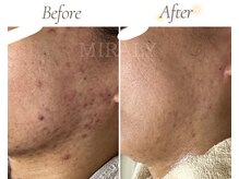 ミラリー(MIRALY)/赤み肌荒れ跡ケア 12ヶ月(20代)