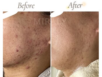 ミラリー(MIRALY)/赤み肌荒れ跡ケア 12ヶ月(20代)