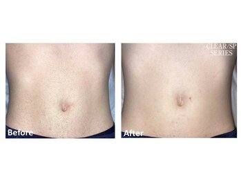 ベルフィオーレ(bel fiore)/メンズ脱毛 お腹