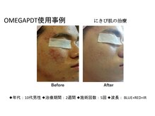 エミット(emit.)/ニキビ徹底改善