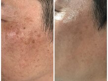 ボディメイキング キキ(Bodymaking KIKI)/イノスピキュール天然HARI