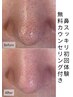 鼻スッキリ初回｜角栓・黒ずみケア＋無料カウンセリング付