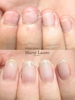 マリーロール 梅田店(Marie Laure)/自爪育成/深爪矯正/ネイルケア
