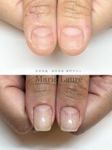 マリーロール 梅田店(Marie Laure)/深爪矯正/自爪育成/自爪風