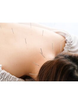 鍼灸施術を受けたい