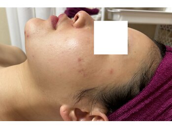 スキンケアスタジオ アコ 新宿店(Aco)/GPソフト１Dのお客様