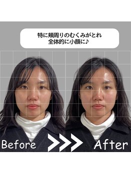 ゆしんアネックス/美容鍼のビフォアフター♪