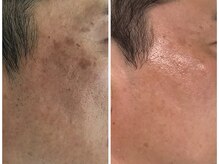 ボディメイキング キキ(Bodymaking KIKI)/イノスピキュール天然HARI