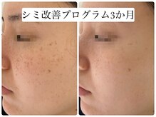 ヌー 栄(nuu)/シミ改善プログラム3か月