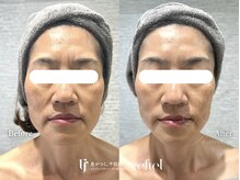 リフィール たまプラーザ店(refiel)/顔のむくみも速攻すっきり♪