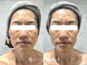 リフィール たまプラーザ店(refiel)/顔のむくみも速攻すっきり♪