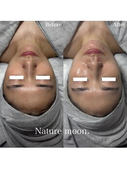 ナチュールムーン(Nature moon.)/ハーブピーリング 
