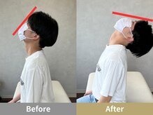 せなかのはね 難波心斎橋店/20代女性 首こり 猫背 頭痛