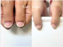 アーティネイルズ(Aaty Nails)/【深爪矯正】ハンド