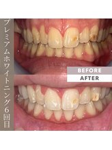 ビューティリュクス(beauty luxe)/プレミアムセルフホワイトニング