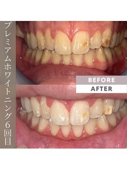 ビューティリュクス(beauty luxe)/プレミアムセルフホワイトニング