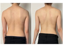 モア(moa)/1回でスッキリとしたお背中に！