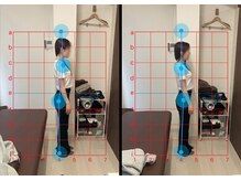 とるこり美姿整体院 新宿院/20代女性-姿勢矯正Before/After