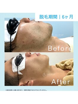 メンズクリア 上水戸ドンキ店/【メンズクリア】お客様の施術例